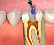 Tratamento de Endodontia