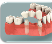 Prótese parcial fixa