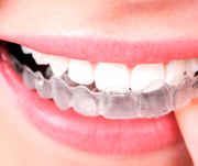 Aparelho INVISALIGN